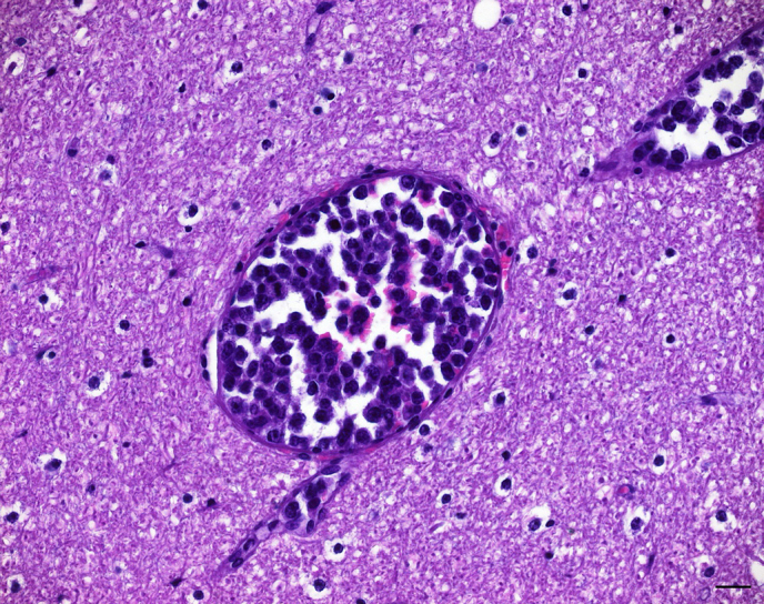 Intravascular T-cell lymphoma in a patas monkey (<i>Erythrocebus patas</i>).