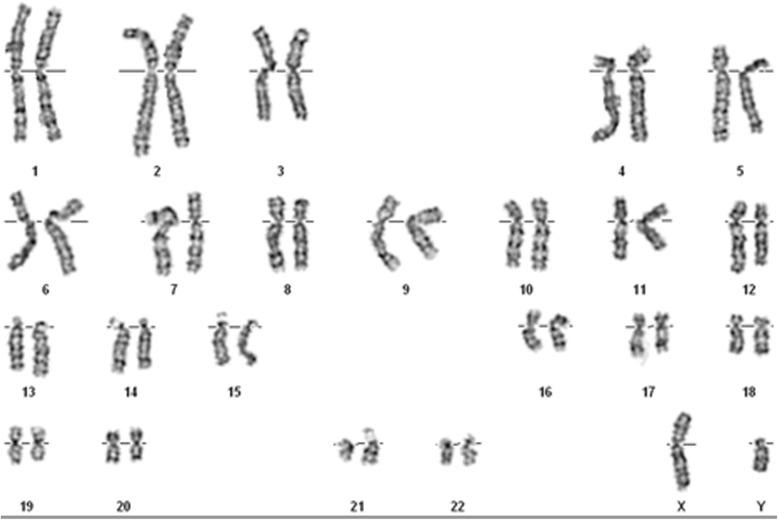 Psychomotor retardation with a 1q42.11-q42.12 deletion.