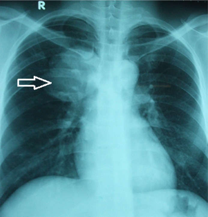 The first report of two cases of cystic echinococcosis in the lung by <i>Echinococcus ortleppi</i> infection, in Vietnam.