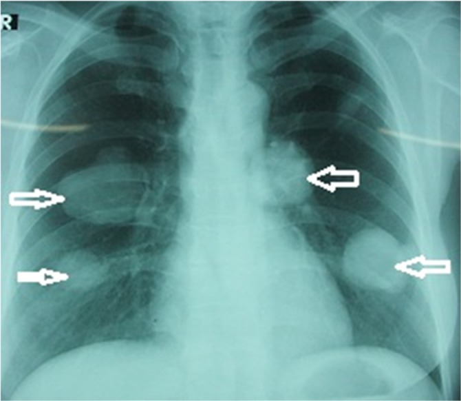 The first report of two cases of cystic echinococcosis in the lung by <i>Echinococcus ortleppi</i> infection, in Vietnam.