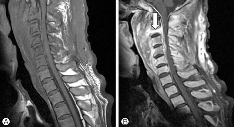 Destruction of the C2 Body due to Cervical Actinomycosis: Connection between Spinal Epidural Abscess and Retropharyngeal Abscess.