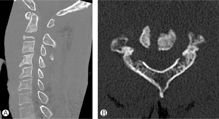 Destruction of the C2 Body due to Cervical Actinomycosis: Connection between Spinal Epidural Abscess and Retropharyngeal Abscess.