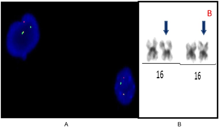 Acute Myeloid Leukemia With Inv(16)(p13q22) Associated With Hidden Systemic Mastocytosis: Case Report and Review of Literature.