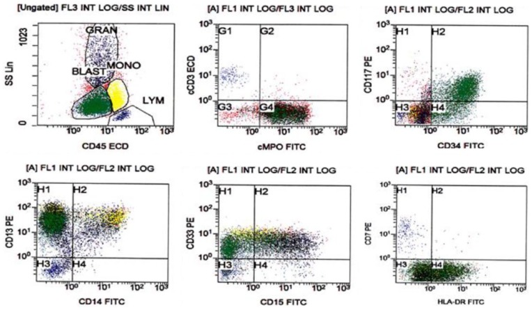 Acute Myeloid Leukemia With Inv(16)(p13q22) Associated With Hidden Systemic Mastocytosis: Case Report and Review of Literature.