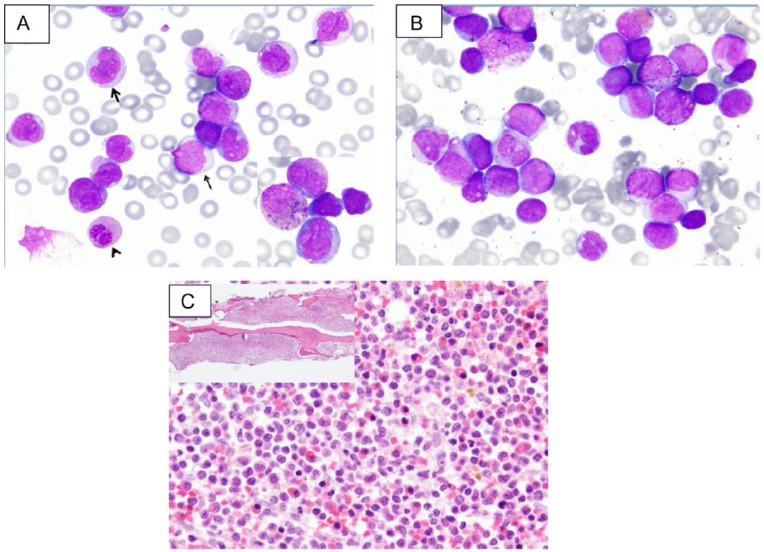 Acute Myeloid Leukemia With Inv(16)(p13q22) Associated With Hidden Systemic Mastocytosis: Case Report and Review of Literature.