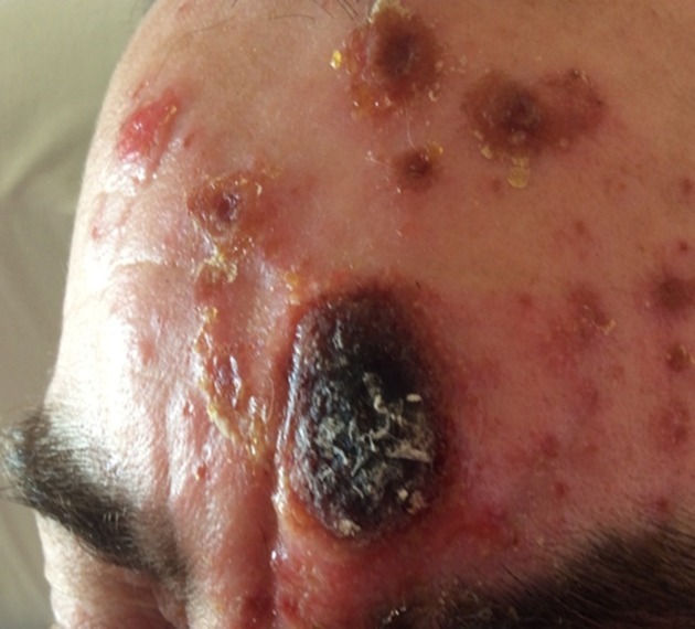 Skin infection caused by a novel strain of <i>Staphylococcus pseudintermedius</i> in a Siberian husky dog owner.