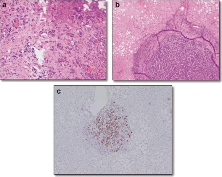 Pancreatic Endocrine Neoplasm Concomitant with a Complicated Endocrine History: A Case Report and Literature Review.