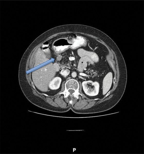 Pancreatic Endocrine Neoplasm Concomitant with a Complicated Endocrine History: A Case Report and Literature Review.