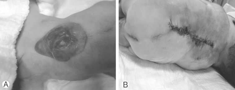 Determination of the Effect of Diameter of the Sac on Prognosis in 64 Cases Operated for Meningomyelocele.