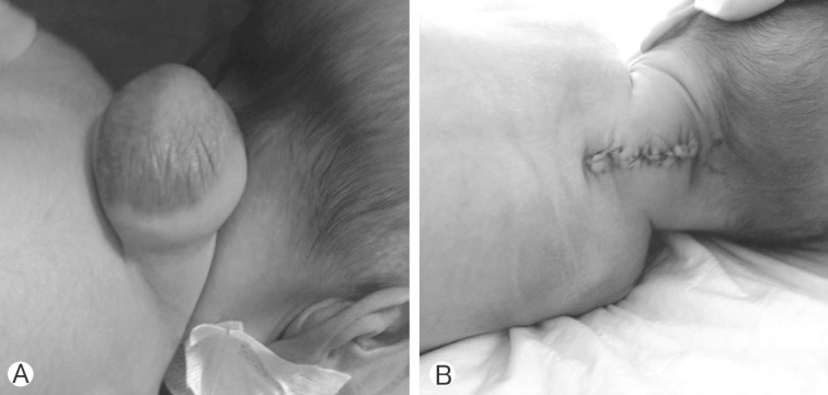 Determination of the Effect of Diameter of the Sac on Prognosis in 64 Cases Operated for Meningomyelocele.