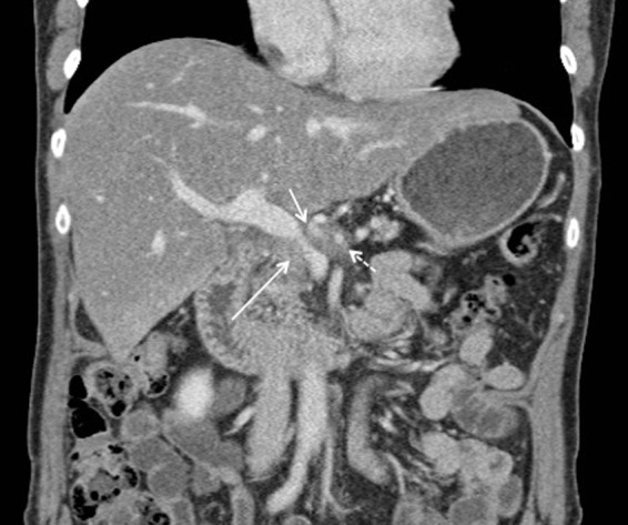 Portal Venous Stenting in Locally Advanced Pancreatic Cancer to Decrease Risk of Thrombosis Before Irreversible Electroporation: A Case Report and Review of the Literature.