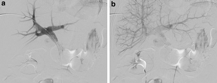 Portal Venous Stenting in Locally Advanced Pancreatic Cancer to Decrease Risk of Thrombosis Before Irreversible Electroporation: A Case Report and Review of the Literature.