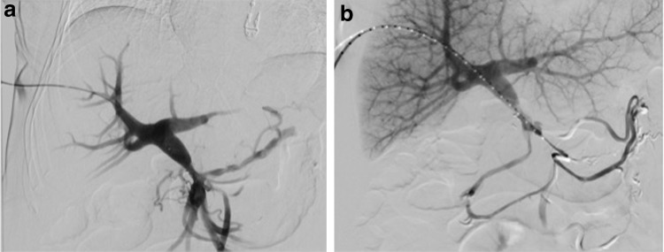 Portal Venous Stenting in Locally Advanced Pancreatic Cancer to Decrease Risk of Thrombosis Before Irreversible Electroporation: A Case Report and Review of the Literature.