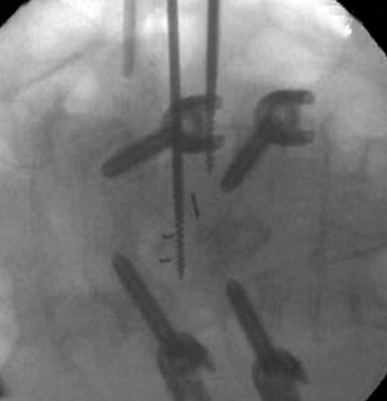 Application of Lateral Approach for the Removal of Migrated Interbody Cage: Taphole and Fixing Technique.