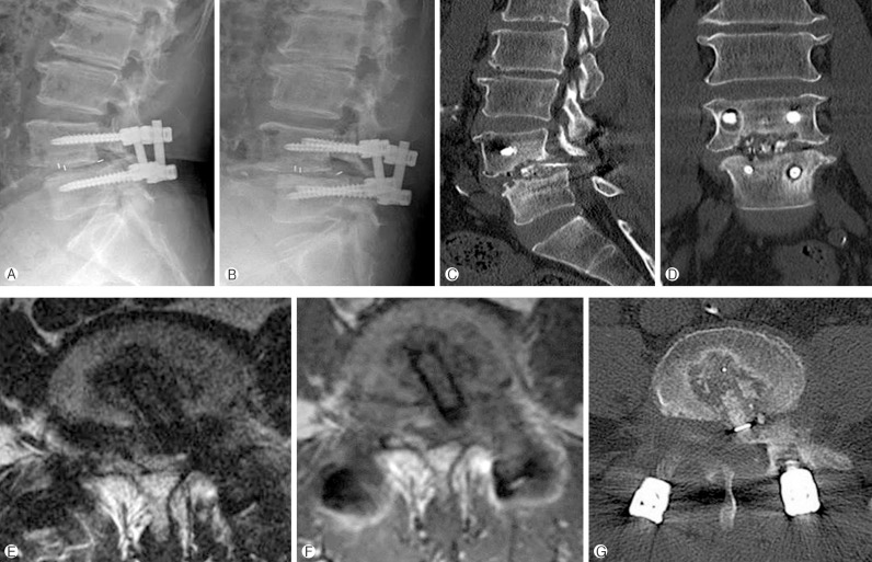 Application of Lateral Approach for the Removal of Migrated Interbody Cage: Taphole and Fixing Technique.