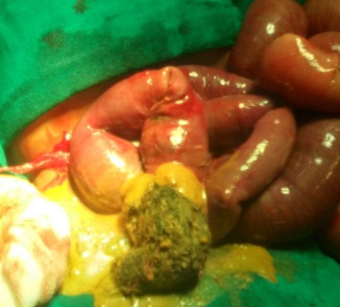 Ileal Trichobezoar Presenting as Intestinal Obstruction and Peritonitis.