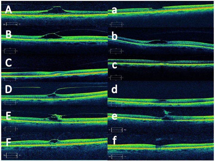 Treatment of Symptomatic Vitreomacular Adhesion with Expansile Sulfur Hexafluoride (SF6) Gas.