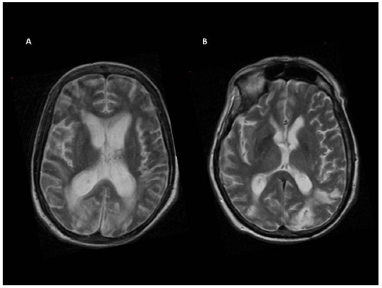 Functional Evaluation of Awareness in Vegetative and Minimally Conscious State.