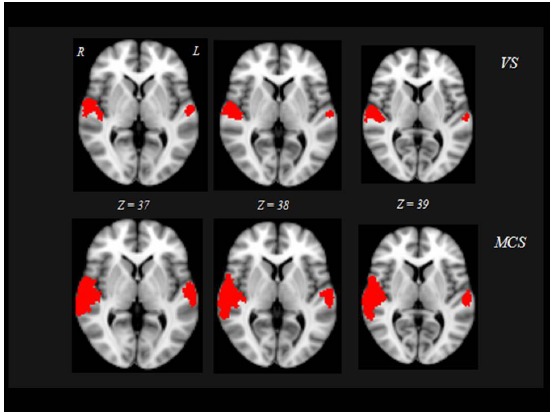 Functional Evaluation of Awareness in Vegetative and Minimally Conscious State.