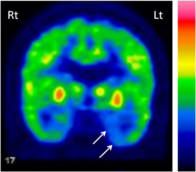 Emotional stimuli-provoked seizures potentially misdiagnosed as psychogenic non-epileptic attacks: A case of temporal lobe epilepsy with amygdala enlargement