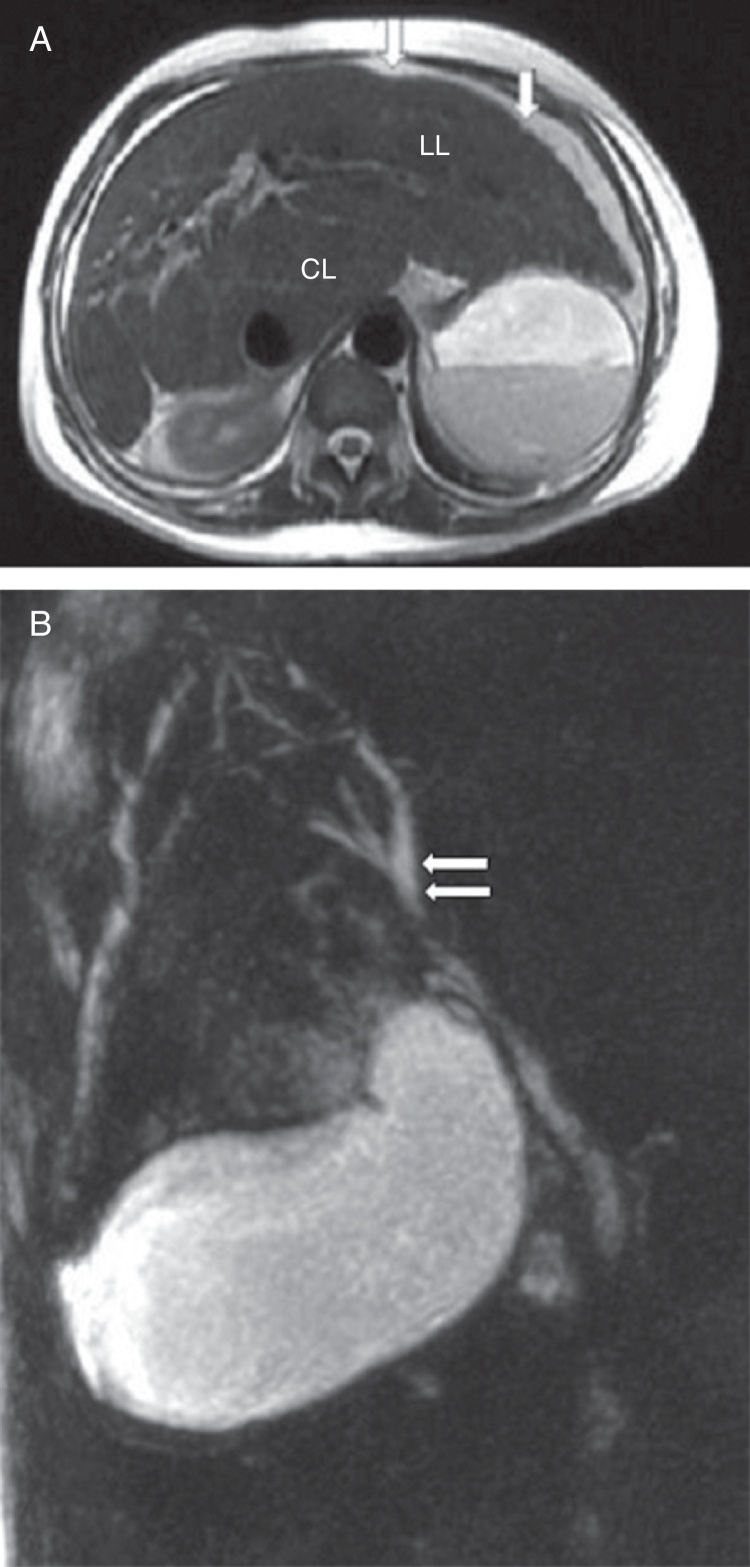 Sickle cell intrahepatic cholestasis unresponsive to exchange blood transfusion: a case report