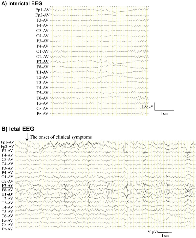 Emotional stimuli-provoked seizures potentially misdiagnosed as psychogenic non-epileptic attacks: A case of temporal lobe epilepsy with amygdala enlargement