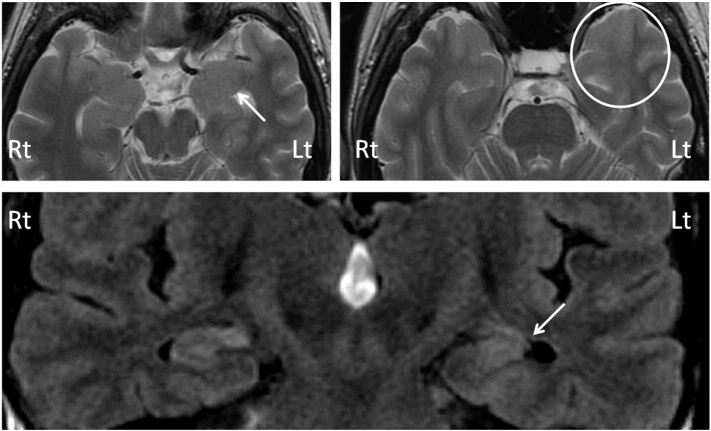 Emotional stimuli-provoked seizures potentially misdiagnosed as psychogenic non-epileptic attacks: A case of temporal lobe epilepsy with amygdala enlargement