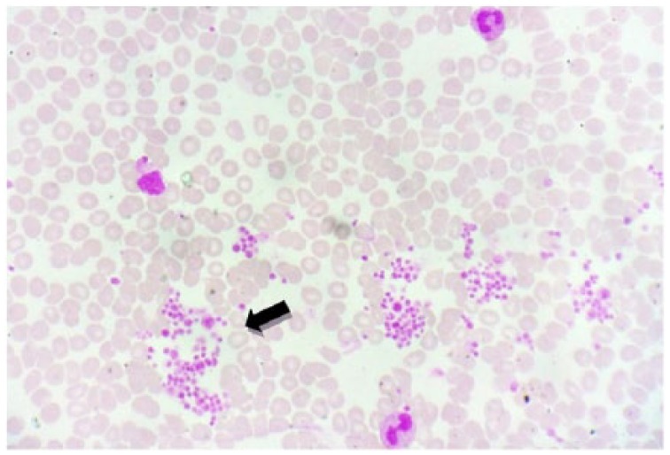 Estimation of Platelet Counts and Other Hematological Parameters in Pseudothrombocytopenia Using Alternative Anticoagulant: Magnesium Sulfate.