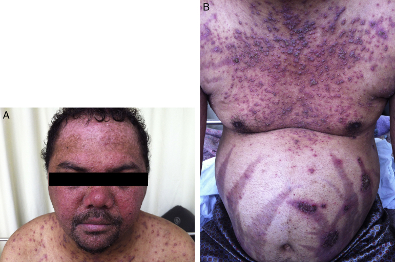 Idiopathic hypereosinophilic syndrome with 20 years of diagnostic delay