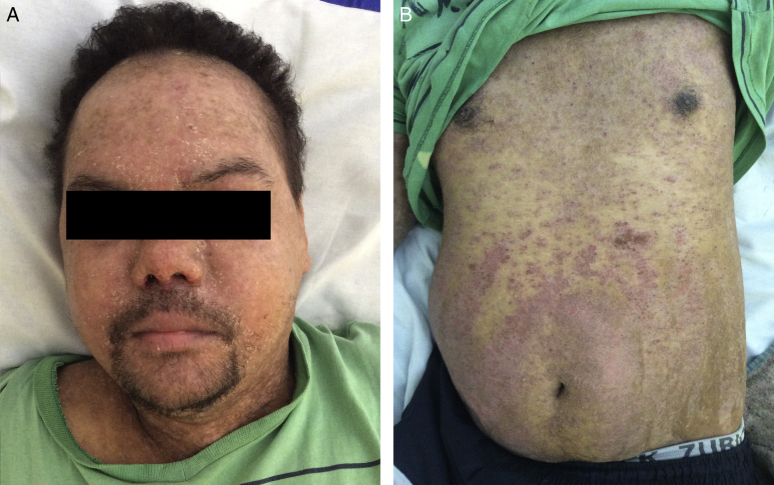 Idiopathic hypereosinophilic syndrome with 20 years of diagnostic delay