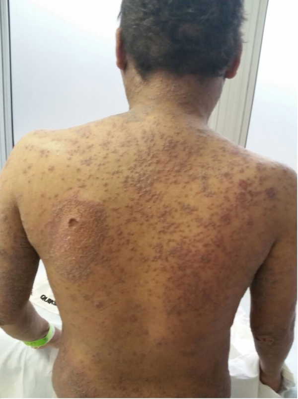 Idiopathic hypereosinophilic syndrome with 20 years of diagnostic delay