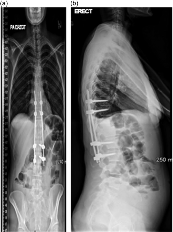 A case of polymicrobial anaerobic spondylodiscitis due to <i>Parvimonas micra</i> and <i>Fusobacterium nucleatum</i>.