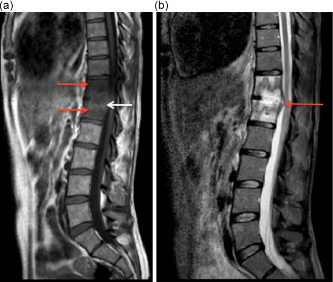 A case of polymicrobial anaerobic spondylodiscitis due to <i>Parvimonas micra</i> and <i>Fusobacterium nucleatum</i>.