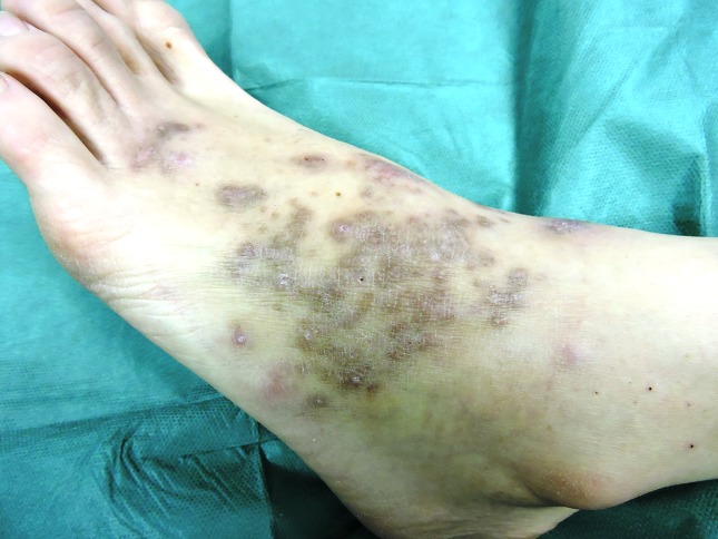 An unusual cutaneous infection caused by <i>Mycobacterium marinum</i>.