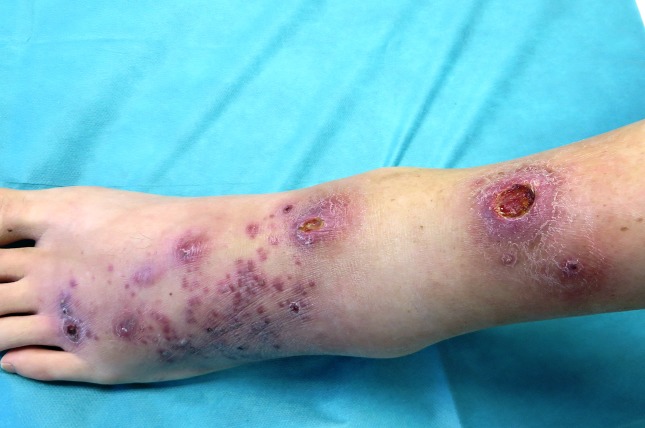 An unusual cutaneous infection caused by <i>Mycobacterium marinum</i>.