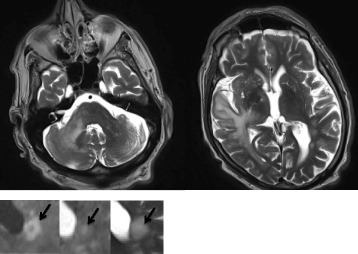 An unusual cause of fatal rapid-onset ataxia plus syndrome.