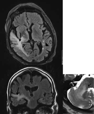 An unusual cause of fatal rapid-onset ataxia plus syndrome.