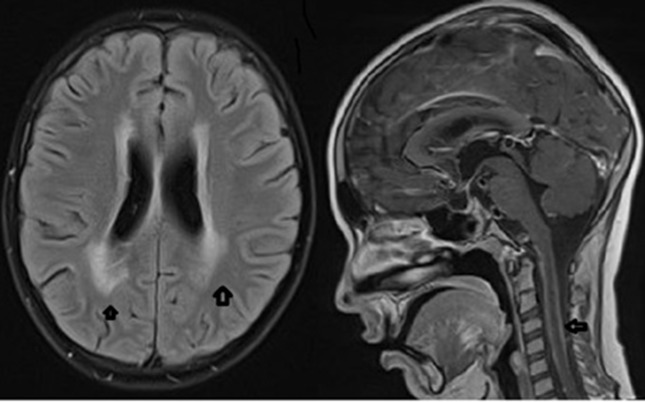 Cerebral vasculitis and intracranial multiple aneurysms in a child with Lyme neuroborreliosis.