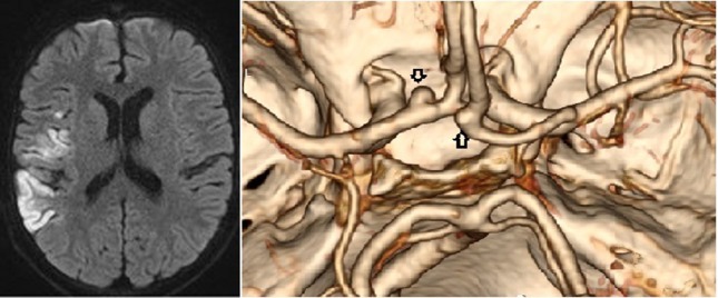 Cerebral vasculitis and intracranial multiple aneurysms in a child with Lyme neuroborreliosis.