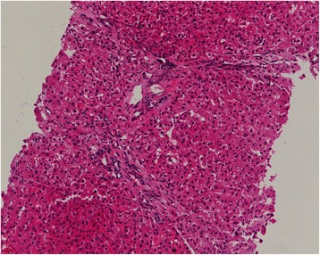 Portal hypertension as the initial manifestation of POEMS syndrome: a case report.