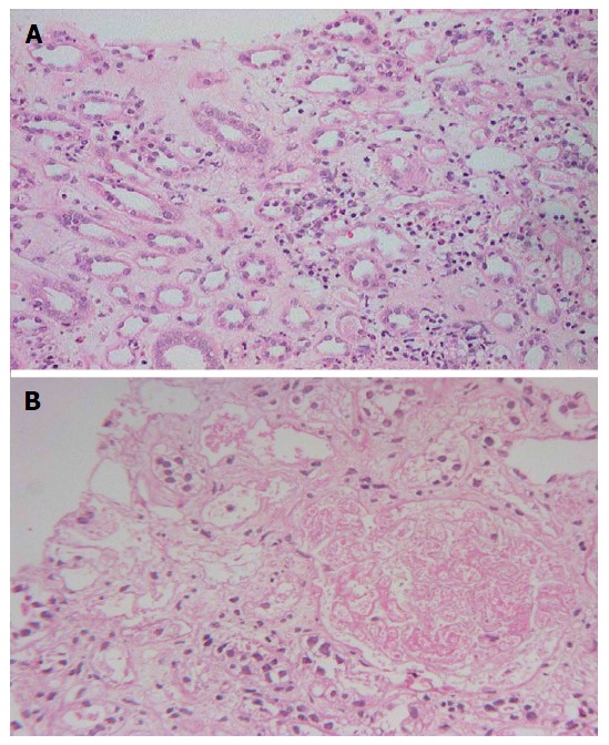 Clinicopathological spectrum of snake bite-induced acute kidney injury from India.