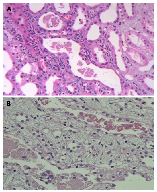 Clinicopathological spectrum of snake bite-induced acute kidney injury from India.