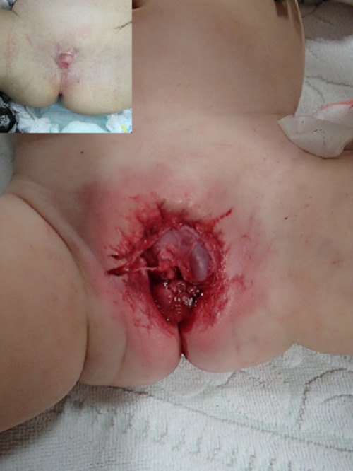Bilateral Testicular Loss due to Dog Bite in a Child.