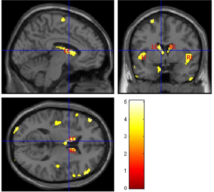 Extending Inferential Group Analysis in Type 2 Diabetic Patients with Multivariate GLM Implemented in SPM8.