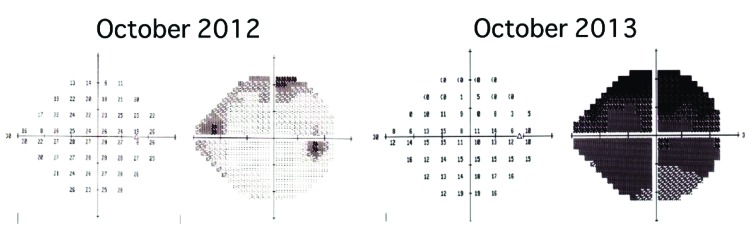 Histological Findings in the Trabecular Meshwork of a Patient with Atopic Glaucoma.