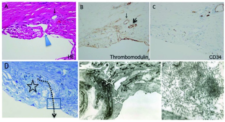 Histological Findings in the Trabecular Meshwork of a Patient with Atopic Glaucoma.