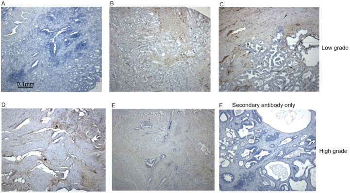 Analysis of Fascin-1 in Relation to Gleason Risk Classification and Nuclear ETS-Related Gene Status of Human Prostate Carcinomas: An Immunohistochemical Study of Clinically Annotated Tumours From the Wales Cancer Bank.