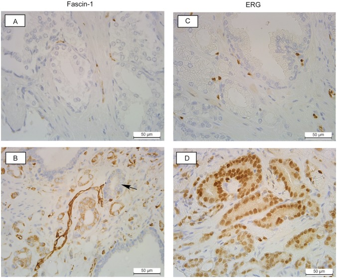 Analysis of Fascin-1 in Relation to Gleason Risk Classification and Nuclear ETS-Related Gene Status of Human Prostate Carcinomas: An Immunohistochemical Study of Clinically Annotated Tumours From the Wales Cancer Bank.