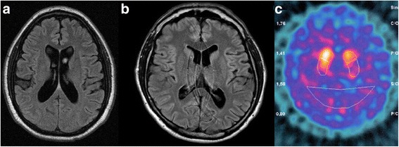 Parkinson disease in Gaucher disease.