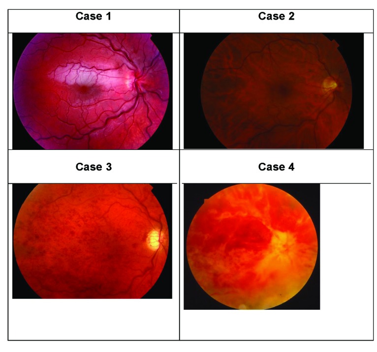 Central Retinal Vein Occlusion in Younger Swedish Adults: Case Reports and Review of the Literature.